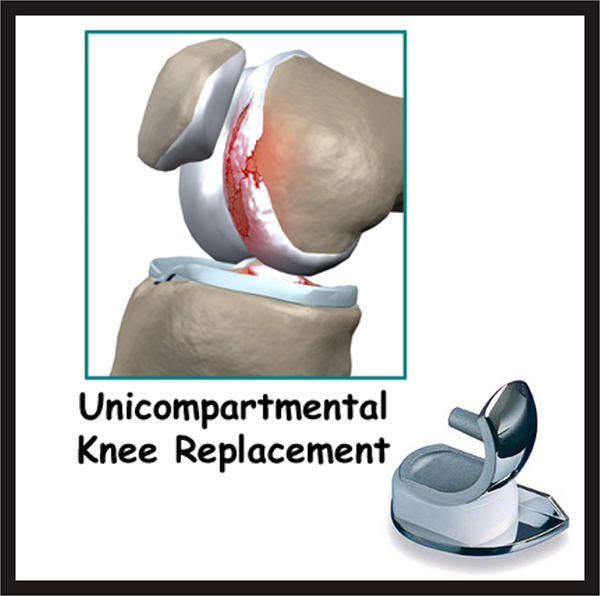 Unicompartmental knee replacement